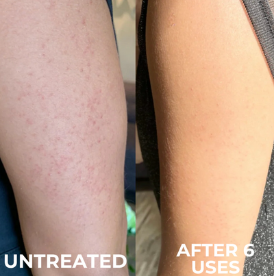 Voreva Triple-Action Keratosis Pilaris Body Treatment