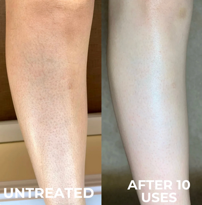 Voreva Triple-Action Keratosis Pilaris Body Treatment