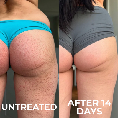Voreva Triple-Action Keratosis Pilaris Body Treatment