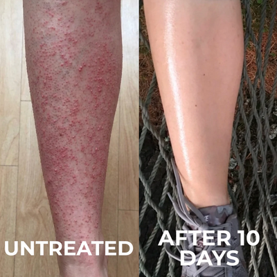 Voreva Triple-Action Keratosis Pilaris Body Treatment