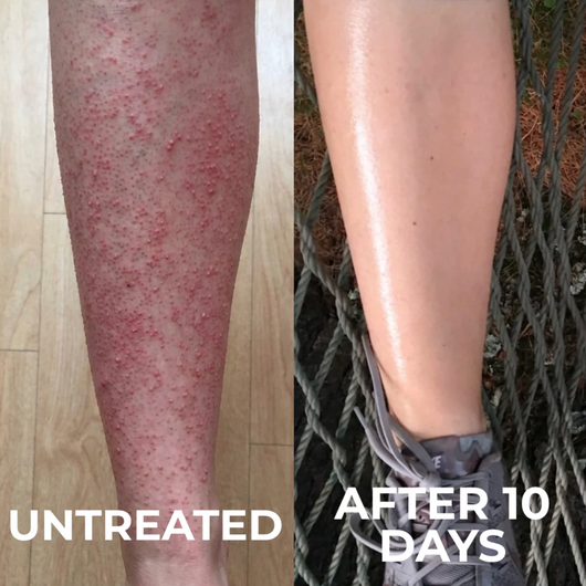 Voreva Triple-Action Keratosis Pilaris Body Treatment